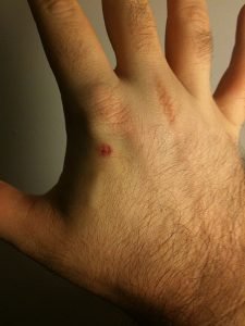 Someone's hand after they had an RFID microchip implanted in it. Some people are starting to do this in Sweden as the country tries to go cashless.